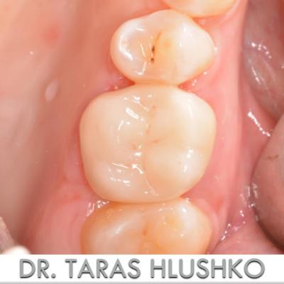 Protezuvannia Na Zubakh V003 003