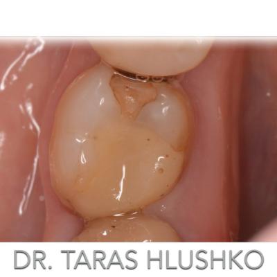 Protezuvannia Na Zubakh V004 002