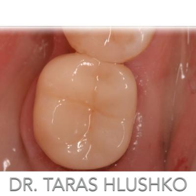 Protezuvannia Na Zubakh V004 003