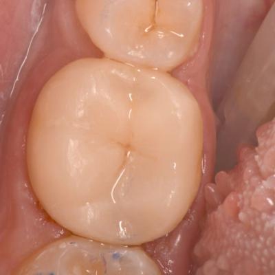 Protezuvannia Na Zubakh V005 I004