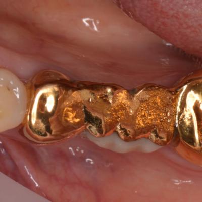 Protezuvannia Na Zubakh V006 I001