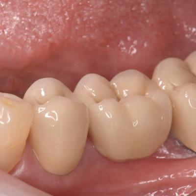 Protezuvannia Na Zubakh V006 I008