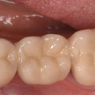 Protezuvannia Na Zubakh V006 I009