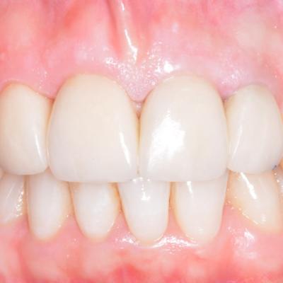 Protezuvannia Na Zubakh V007 I003