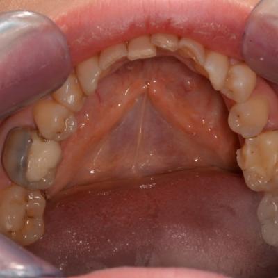 Protezuvannia Na Zubakh V008 003
