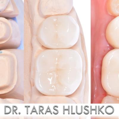 Protezuvannia Na Zubakh V1 I1