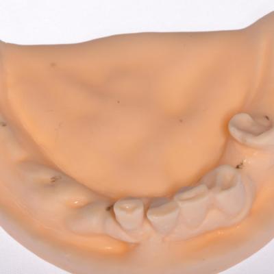 Protezuvannia Na Zubakh Ta Implantakh V6 I2