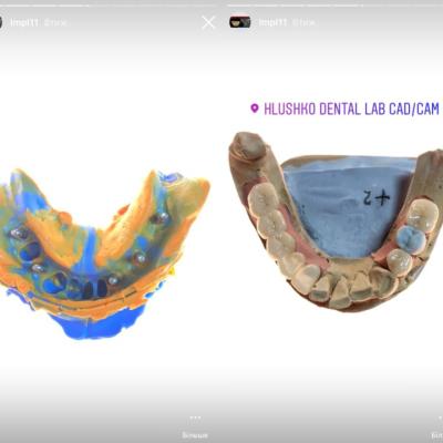 Protezuvannia Na Zubakh Ta Implantakh V6 I6
