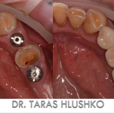 Protezuvannia Na Zubakh Ta Implantakh V6 I8