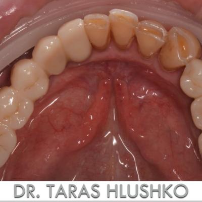 Protezuvannia Na Zubakh Ta Implantakh V6 I9