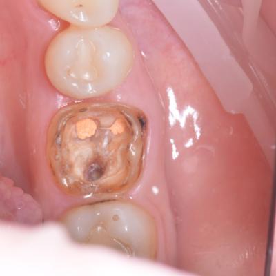 Protezuvannia Na Zubakh V10 I1