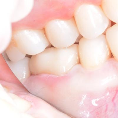 Protezuvannia Na Zubakh V10 I3