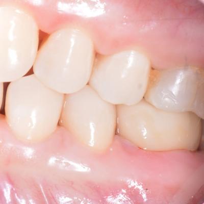 Protezuvannia Na Zubakh V11 I3