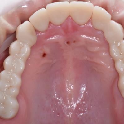 Protezuvannia Na Zubakh V12 I2