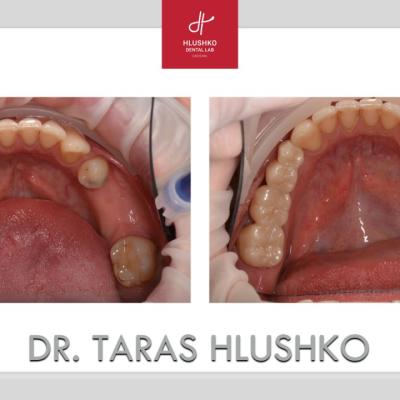 Protezuvannia Na Zubakh V13 I1