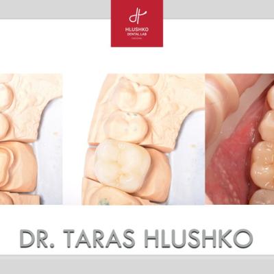 Protezuvannia Na Zubakh V14 I1