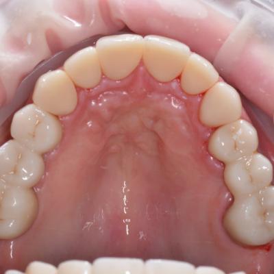 Protezuvannia Na Zubakh Ta Implantakh V001 002