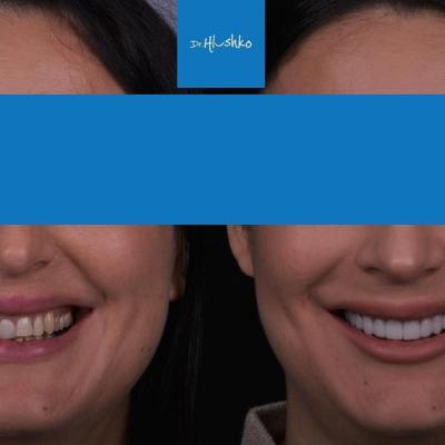 Smile Makeover 03