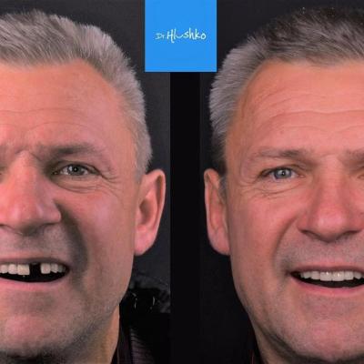 Smile Makeover 07