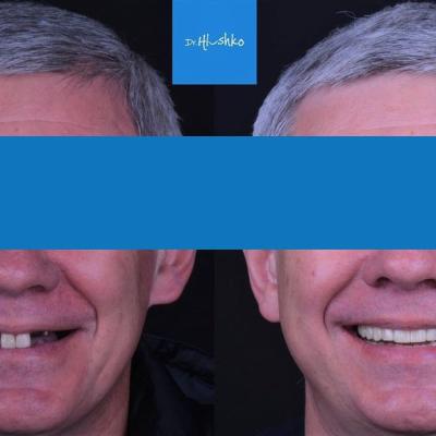 Smile Makeover 10