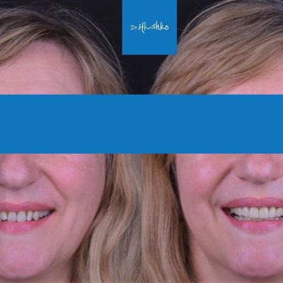 Smile Makeover 12