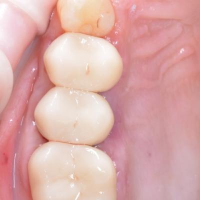 Protezuvannia Na Zubakh V002 002