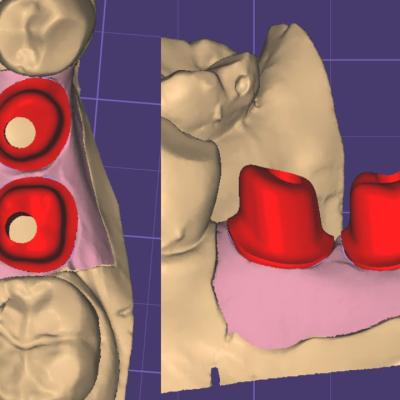 Protezuvannia Na Zubakh Ta Implantakh V003 002